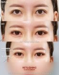Блефаропластика до и после в Returning Plastic Surgery, результат коррекции век
