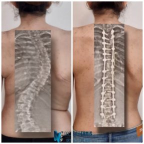 Before and after scoliosis surgery results at Central Hospital, visible spine correction