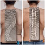 Before and after scoliosis surgery results at Central Hospital, visible spine correction