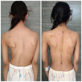 Before and after scoliosis surgery results at Central Hospital, visible spine alignment improvement