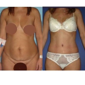 Before and after liposuction results at Memorial Bahçelievler Hospital, improved body contour