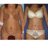 Before and after liposuction results at Memorial Bahçelievler Hospital, improved body contour