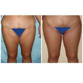 Before and after liposuction results at Memorial Bahçelievler Hospital, improved thigh contour