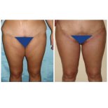 Before and after liposuction results at Memorial Bahçelievler Hospital, improved thigh contour