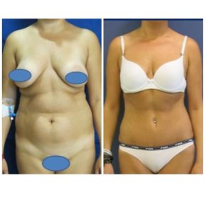 Before and after liposuction results at Memorial Bahçelievler Hospital, improved body contour