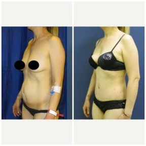 Before and after liposuction results at Memorial Bahçelievler Hospital, improved body contour