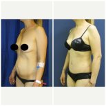 Before and after liposuction results at Memorial Bahçelievler Hospital, improved body contour