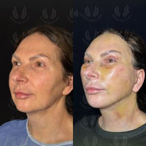 before-after photo deep-plane-facelift