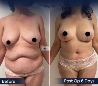 before-after photo mastopexy-breast-lift-contour-plastics