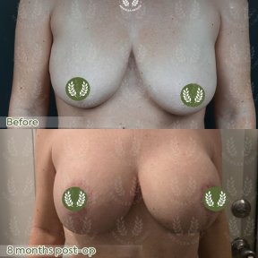 before-after photo mastopexy-breast-lift-contour-plastics