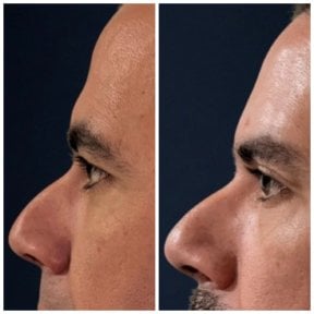 before-after photo blepharoplasty-eyelid