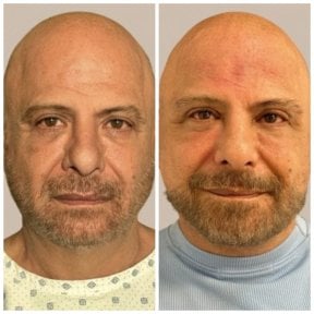 before-after photo blepharoplasty-eyelid