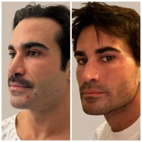 before-after photo blepharoplasty-eyelid
