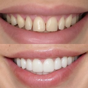 Resultado antes y después de carillas: sonrisa transformada con dientes blancos y parejos