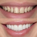 Resultado antes y después de carillas: sonrisa transformada con dientes blancos y parejos