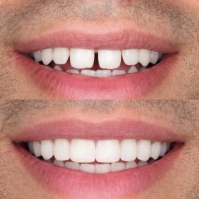Before and after veneers procedure results – improved smile and aligned teeth transformation