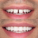 Before and after veneers procedure results – improved smile and aligned teeth transformation