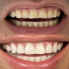 Vorher-nachher-Ergebnis Veneers – verbesserte Ästhetik und weißere Zähne