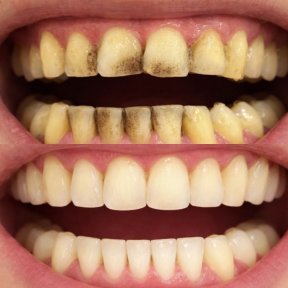 Resultados antes y después de carillas dentales: dientes más blancos y uniformes