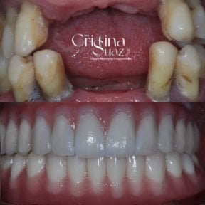Before and after dental implant results at Dra. Cristina Suazo clinic, restored healthy smile