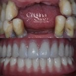 Before and after dental implant results at Dra. Cristina Suazo clinic, restored healthy smile