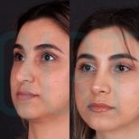 Resultados de rinoplastia antes y después en Quartz Hospital, remodelación nasal natural