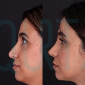 نتائج تجميل الأنف قبل وبعد في Quartz Hospital، إعادة تشكيل الأنف بمظهر طبيعي