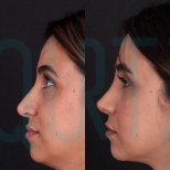 نتائج تجميل الأنف قبل وبعد في Quartz Hospital، إعادة تشكيل الأنف بمظهر طبيعي