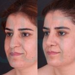 نتائج عملية تجميل الأنف قبل وبعد في Quartz Hospital، تحسين شكل الأنف وتناسق الوجه