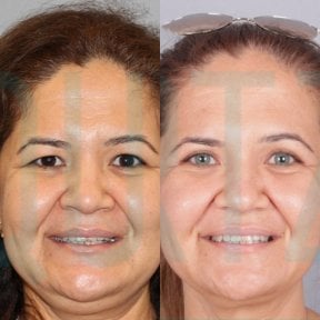 before-after photo deep-plane-facelift