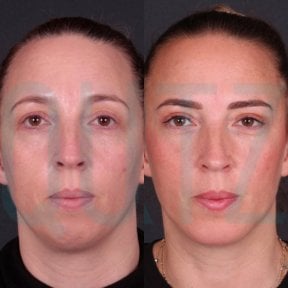 before-after photo deep-plane-facelift