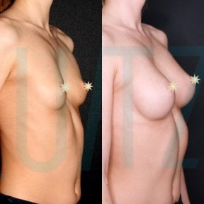 before-after photo podtazka-grudi-s-uveliceniem