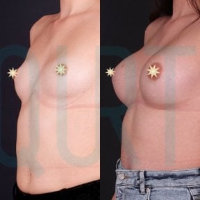before-after photo podtazka-grudi-s-uveliceniem