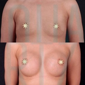 before-after photo podtazka-grudi-s-uveliceniem