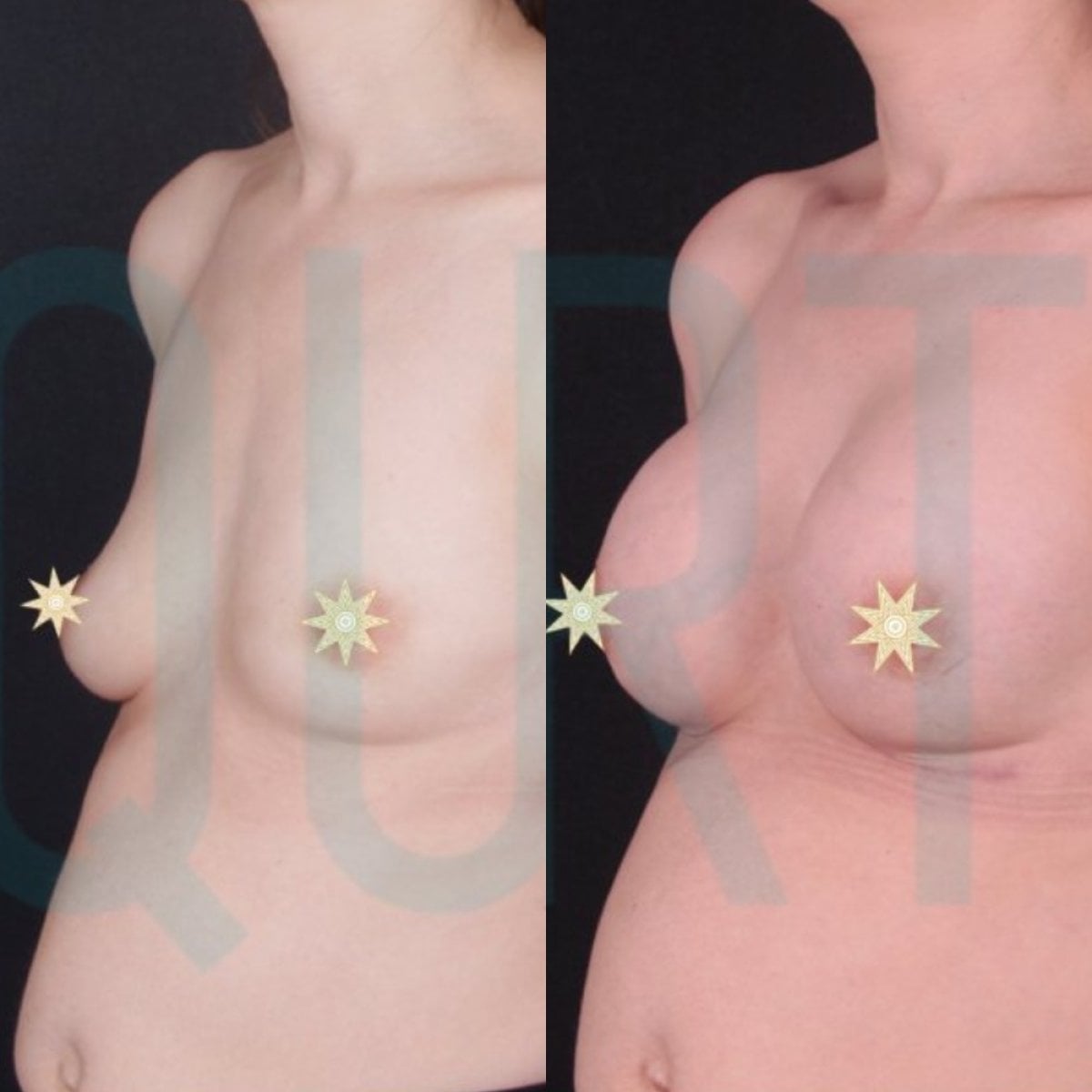 Antes y después de implantes mamarios con lifting en Quartz Hospital, resultado mejorado