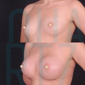 before-after photo podtazka-grudi-s-uveliceniem