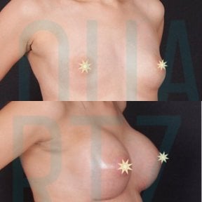 before-after photo podtazka-grudi-s-uveliceniem