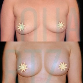 before-after photo podtazka-grudi-s-uveliceniem