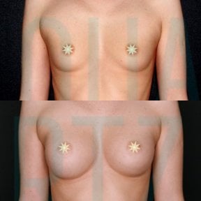 before-after photo podtazka-grudi-s-uveliceniem