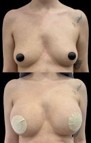before-after photo breast-augmentation