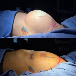 before-after photo breast-augmentation