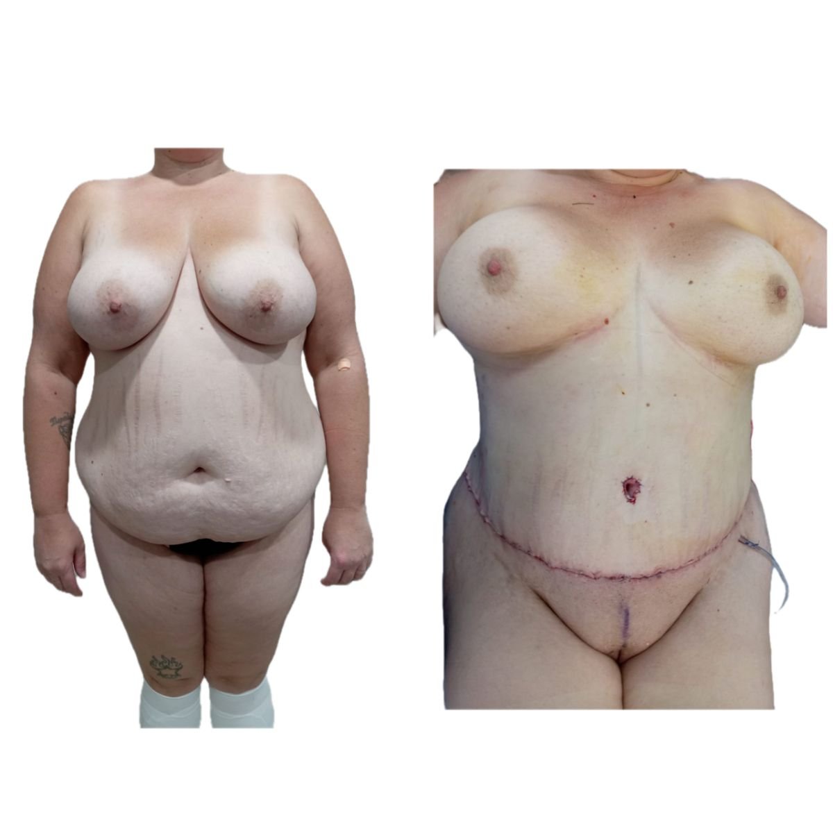 Resultados antes y después de mommy makeover en Hospital de la Familia, contorno corporal visible