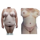 Resultados antes y después de mommy makeover en Hospital de la Familia, contorno corporal visible