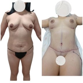 نتائج قبل وبعد عملية تجميل الأم في مستشفى دي لا فاميليا، تحسين شكل الجسم