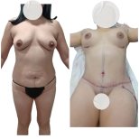 Resultados antes y después de mommy makeover en Hospital de la Familia, mejora del contorno corporal