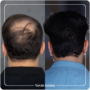 Resultados de trasplante capilar antes y después en Novin Ariana – cabello más denso