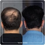 Resultados de trasplante capilar antes y después en Novin Ariana – cabello más denso