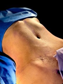 before-after photo liposuction