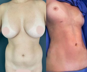 before-after photo liposuction