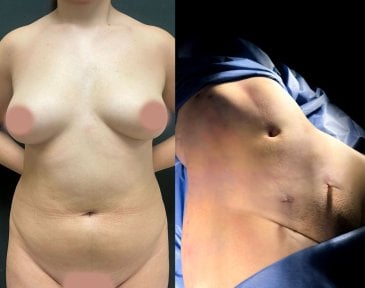 before-after photo liposuction